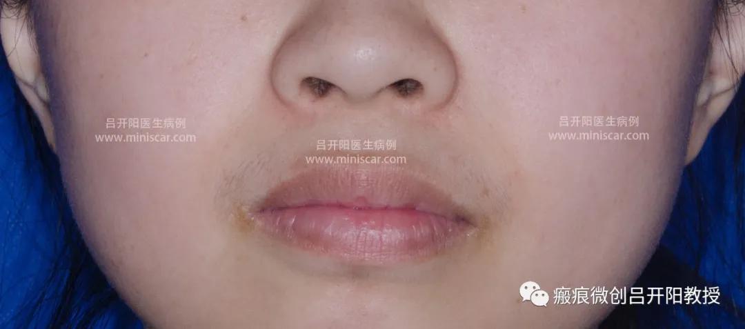 强脉冲激光治疗脸部视频,点阵激光嫩肤