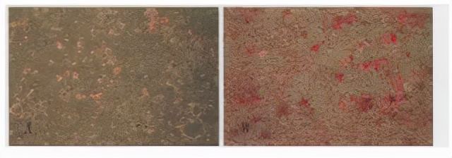 干细胞治疗帕金森最新新闻,干细胞治疗脑瘫央视报道