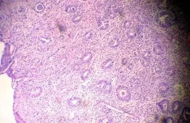 临床医生：3分钟看懂，胃镜活检病理报告！一定要收藏