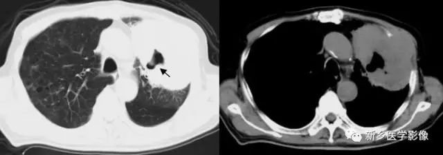 肺部基础免疫,肺基础疾病有哪些