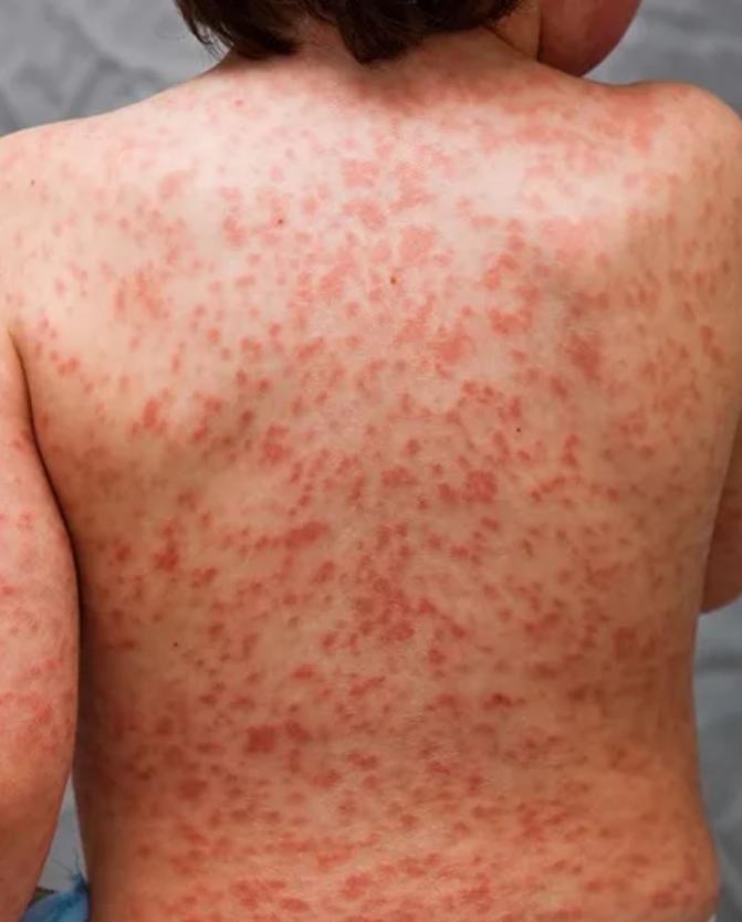 哪些国家有儿童感染新冠病毒的,现在新冠病毒儿童最新症状