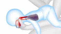 宝宝异物卡喉怎么办,异物卡喉海姆立克急救法多久有效