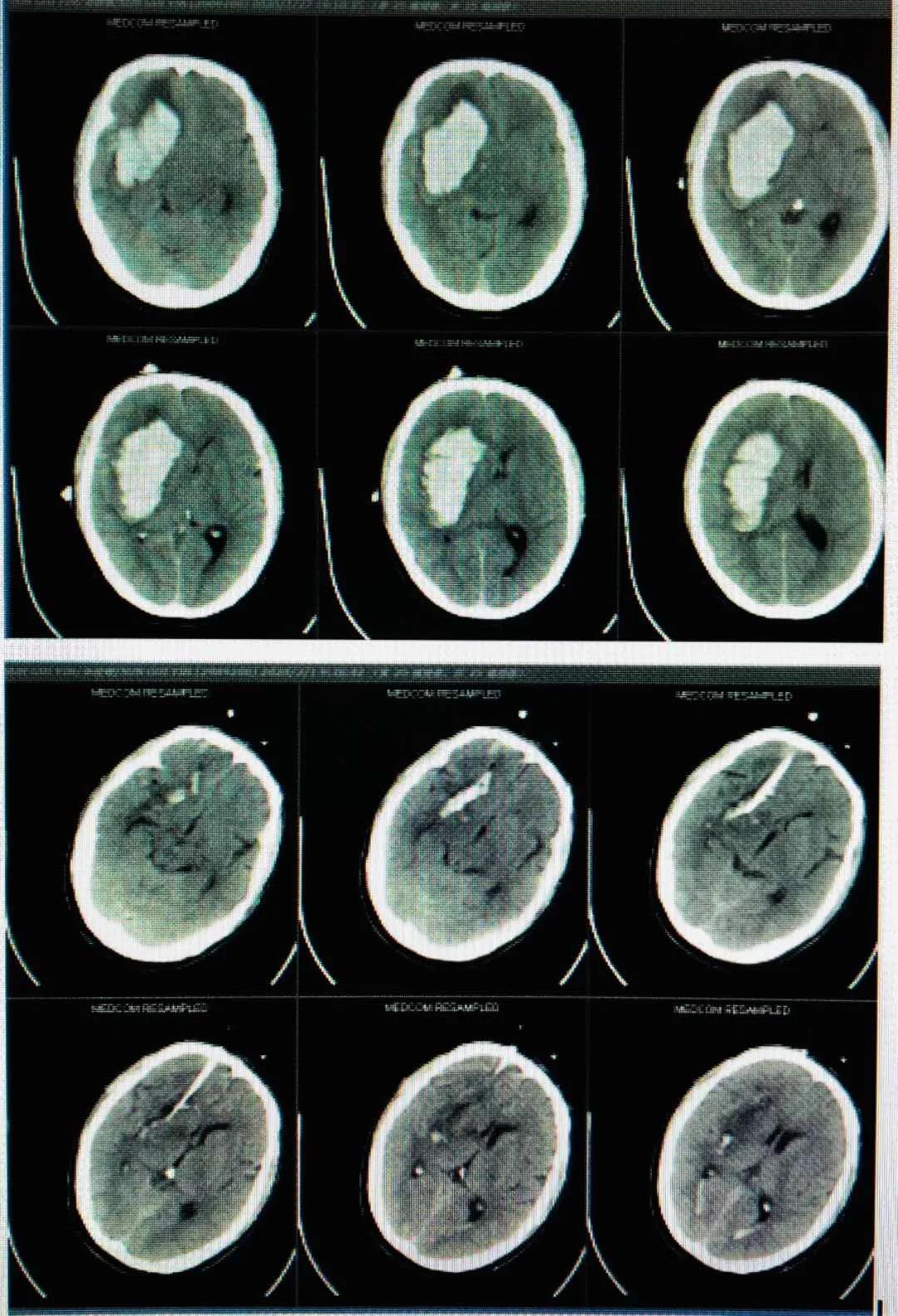 泉州:突破!永春县总医院成功开展新技术