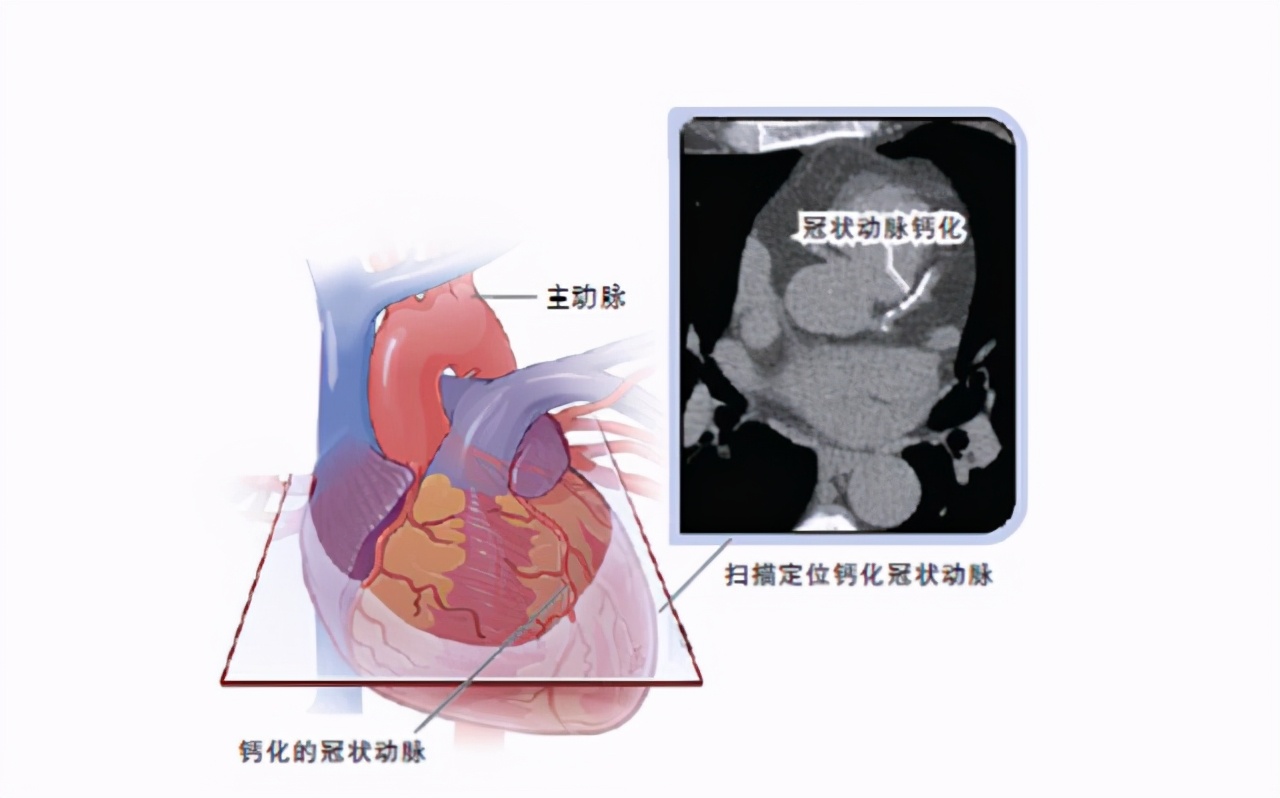 冠状动脉钙化和粥样硬化哪个严重,冠状动脉钙化和硬化哪个严重