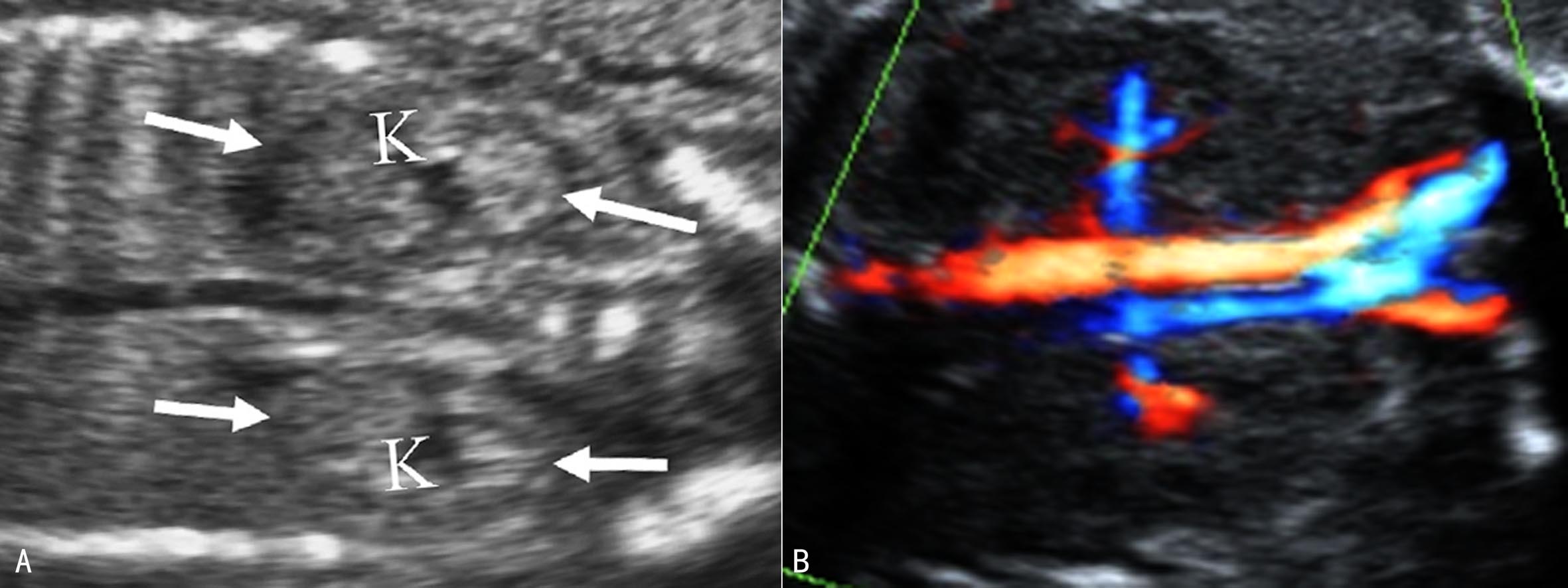 孕期不能忽视的胎儿超声检查,胎儿超声检查报告表