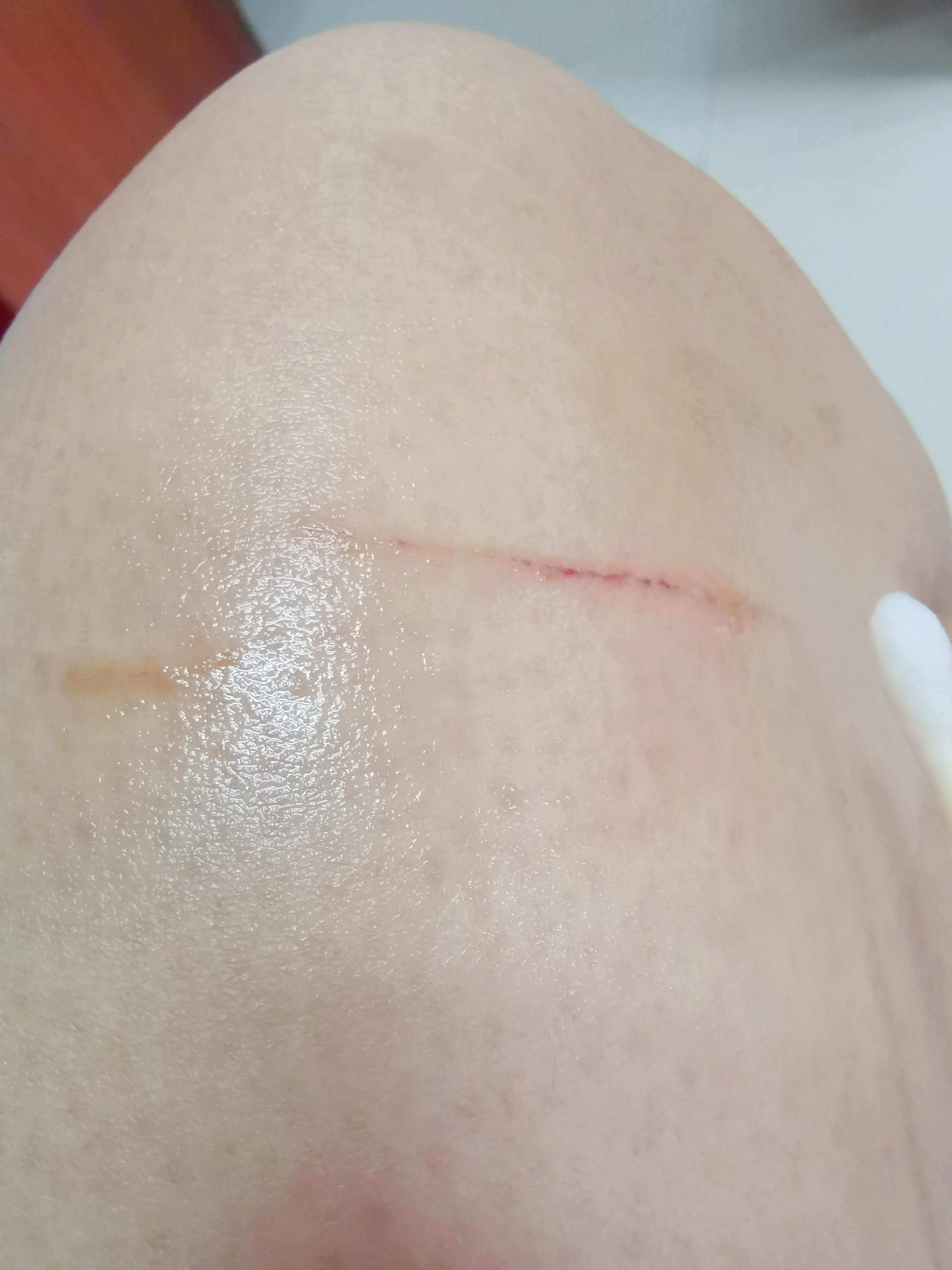 打过疫苗的猫咪抓伤出血,打了疫苗的猫咪抓伤了要打针吗