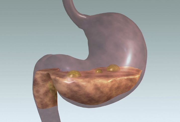 幽门螺杆菌有必要吃药根除吗,治疗幽门螺杆菌需要去三甲医院吗