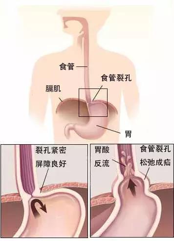 老是烧心胸部疼,喉咙有异物感烧心胸痛咋回事