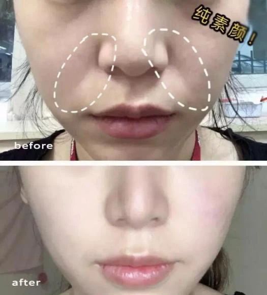 杨紫近照曝光无修图法令纹很深,杨紫面部填充法令纹