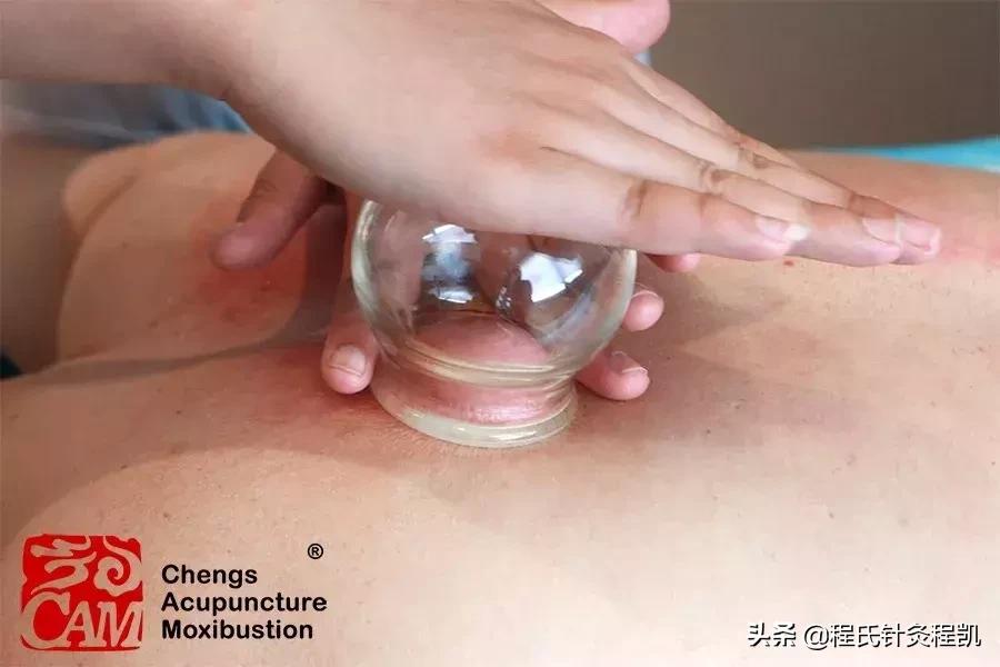 腰痛有寒湿气怎样拔火罐,寒湿腰痛一招解决