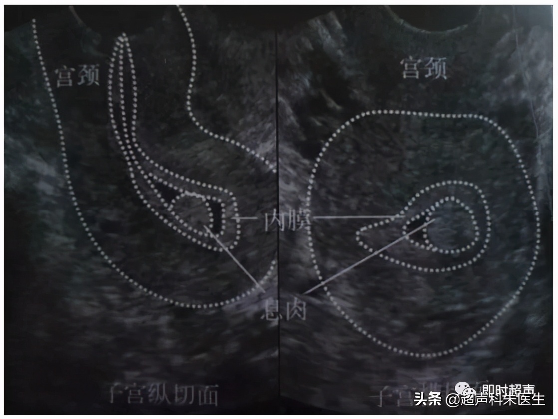 妇科超声的标准超声图,妇科超声图解
