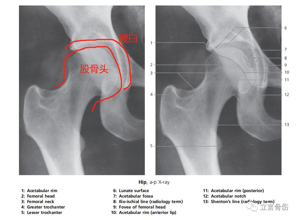 股骨髋臼撞击综合征吃哪些药呢,股骨髋臼撞击综合征做手术多少钱