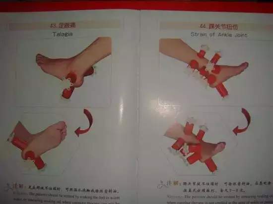 拔罐有哪些穴位图解,最全拔罐穴位疗法图解