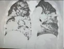 卒中后肺炎指南,脑卒中引起的肺部感染护理措施