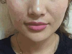 线雕只做一次会有后遗症吗,线雕只提升外轮廓吗