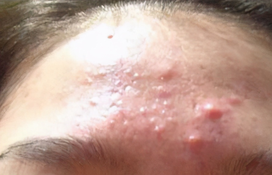 痘痘可以挤吗正确处理方法告诉你,教你正确的挤青春痘的方法