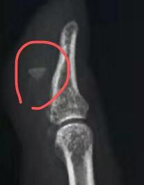 手指被扎了有异物挂什么科,手指被刺伤用什么药