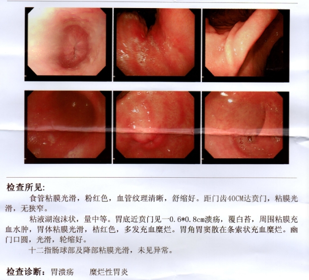 中医治疗萎缩性胃炎伴糜烂的医案,萎缩性胃炎治愈100例