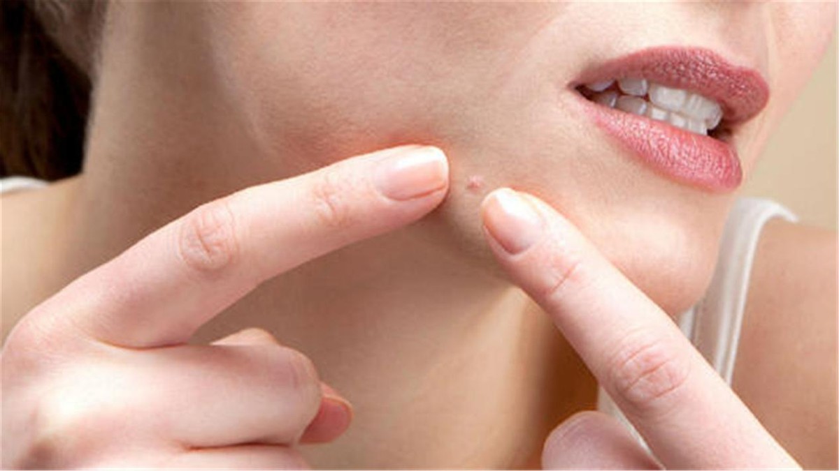 “危险三角区”的痘痘千万不能挤！有人挤了一下，结果留下后遗症