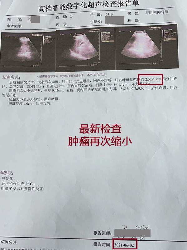 肝癌新发病例,肝癌肿瘤破裂出血会转移吗