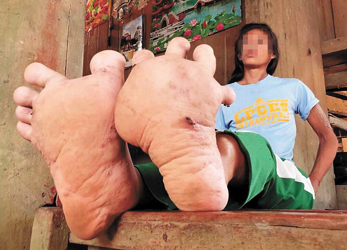 巨指症畸形,儿童巨指畸形因为什么引起的