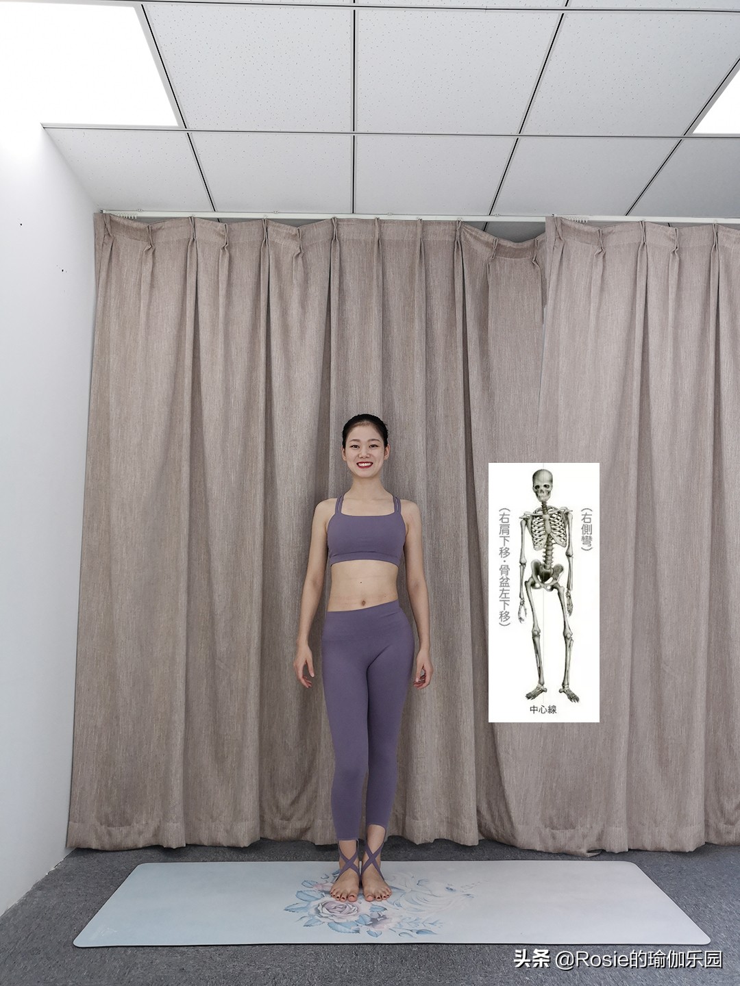 大腿根缝隙大o型腿怎么矫正,穿软鞋子造成o型腿怎么矫正