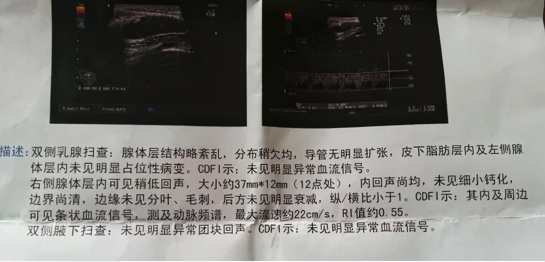 乳腺b超报告该怎么看,乳腺b超报告部分呈点片状低回声