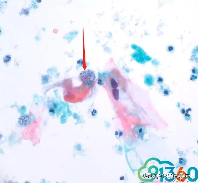 宫颈病理检查与tct检查的区别,病理诊断宫颈活检鳞癌