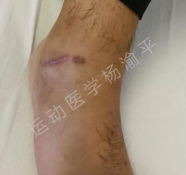 崴脚了韧带损伤需要康复还是静养,崴脚伤到筋后做什么动作康复