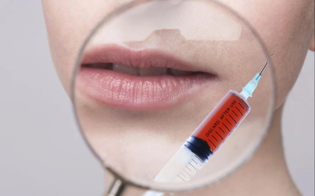 暴利的玻尿酸,玻尿酸真的有多大暴利