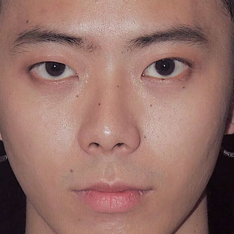 脸上长的痣有哪些是不可以取的,脸上长黑痣会影响颜值吗