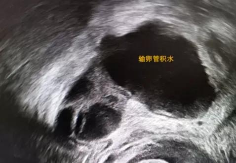 输卵管积水做宫腔镜能处理吗,输卵管积水做腹腔镜主要怎么处理