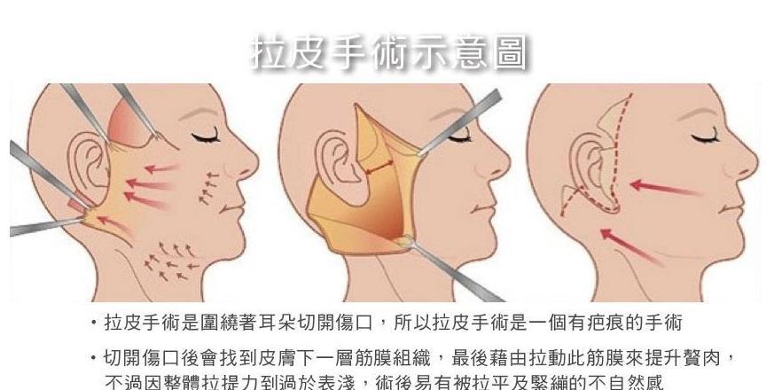 42岁做拉皮还是线雕,做线雕一年后可以做拉皮术吗