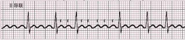 心房颤动是什么病如何治疗,阵发性心房扑动怎么查病因