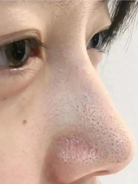 深度清理毛孔黑头教程,清洁毛孔里的黑头和白头小妙招