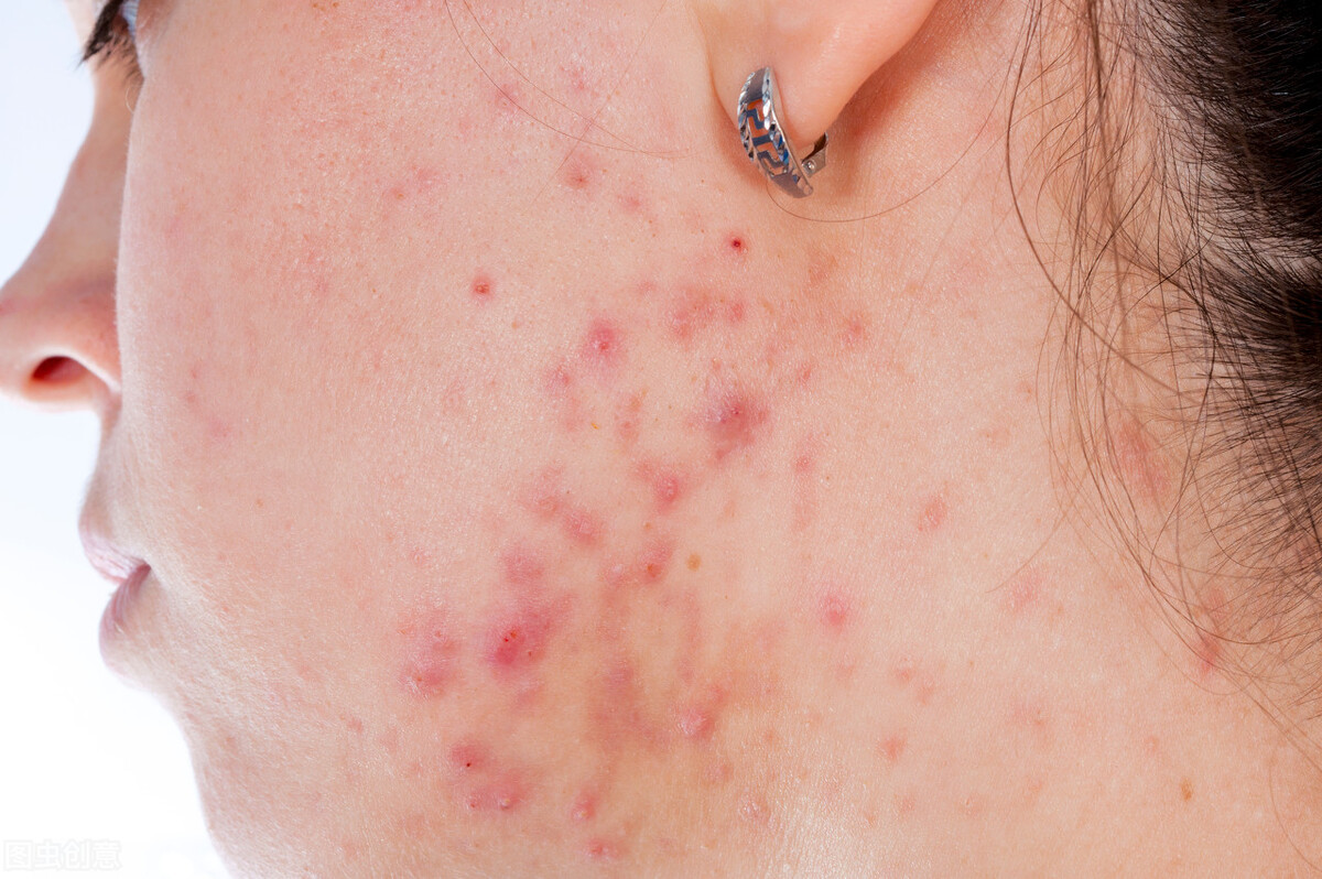 皮肤长疮的最快的治疗方法,长疮的疤怎么去除