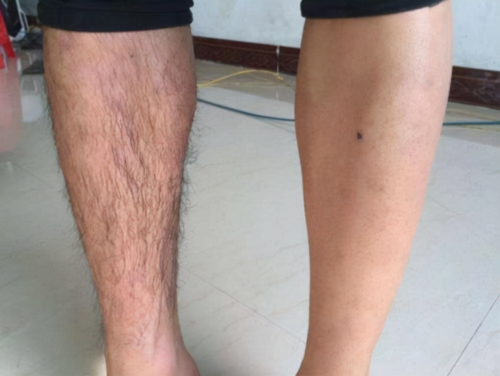 男性腿毛稀少是肾不好吗,男性腿毛少代表什么