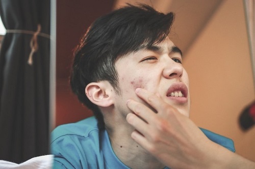 长痘需要去角质的正确方法,长痘后脸可以洗吗