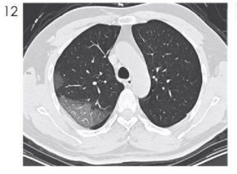 磨玻璃阴影怎么处理,磨玻璃阴影