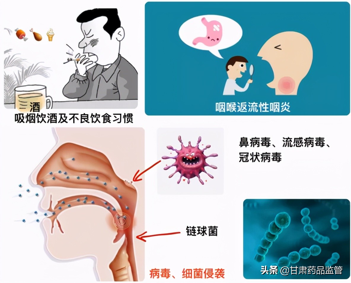 咽炎与咽喉炎的用药区别,咽炎有必要吃药吗