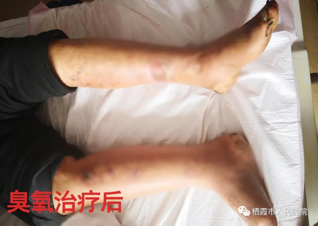 脚气真菌导致脚后跟皮增厚怎么办,脚后跟开裂是真菌还是湿疹