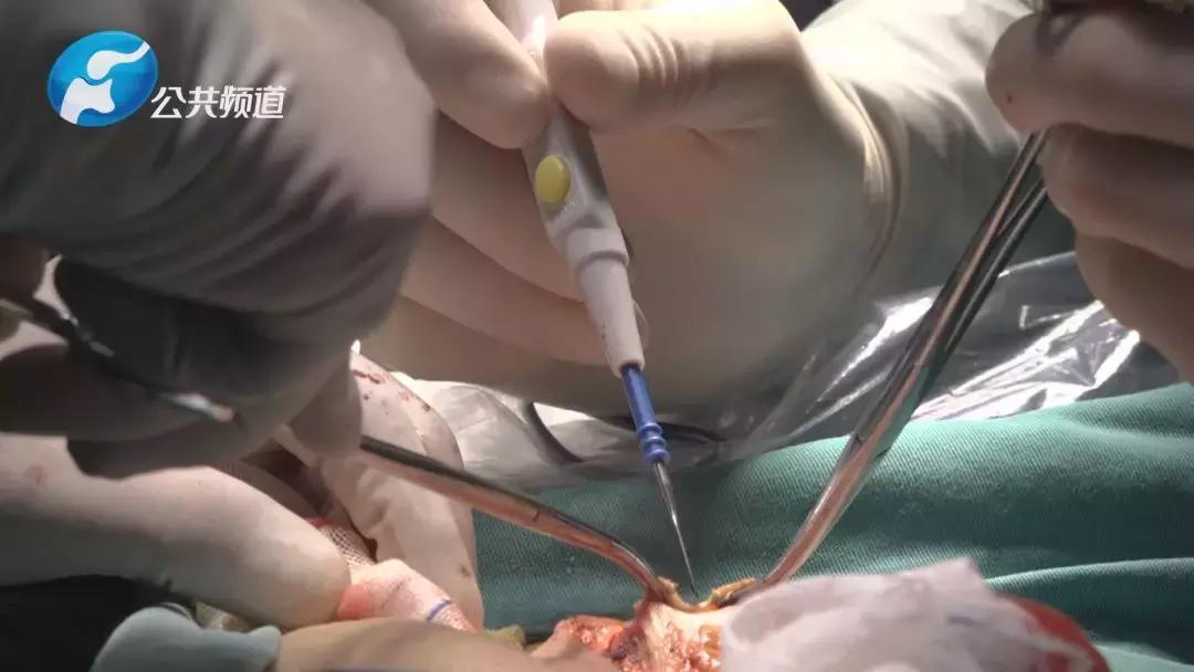 拼搏亮剑|河南大学第一附属医院胸腔镜辅助食管癌根治横结肠代食管手术纪实