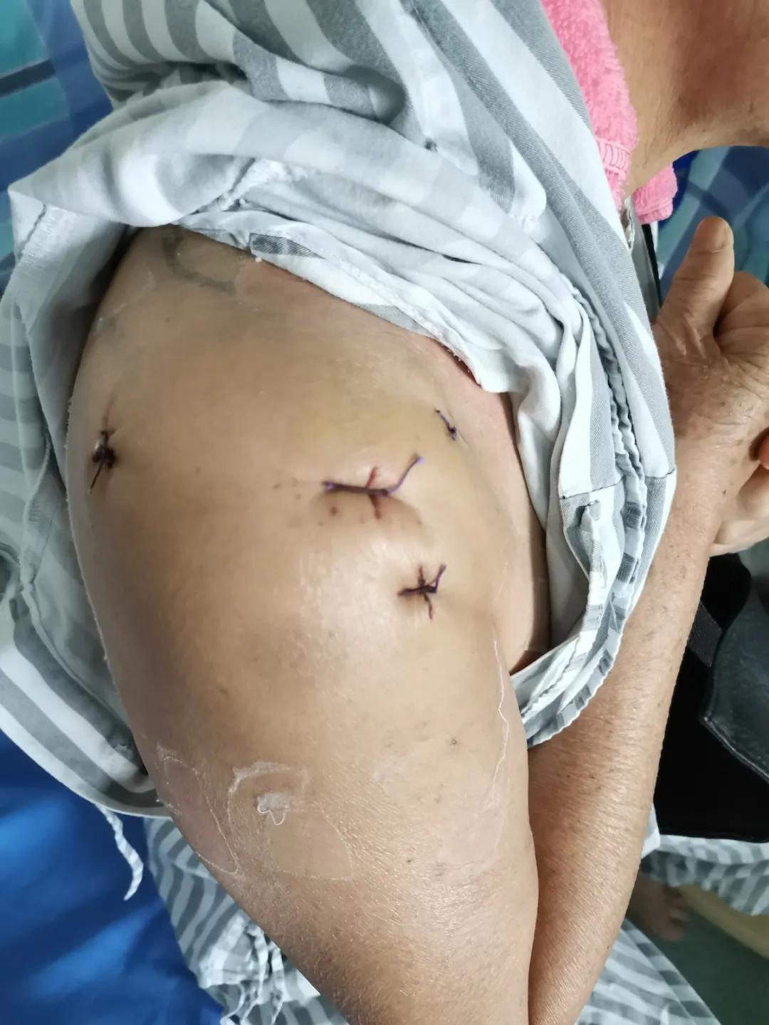 关节镜微创技术对关节炎有用吗,关节镜治疗过程