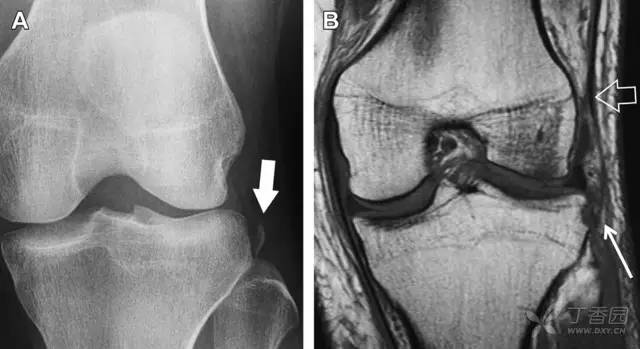常见的八种骨折,容易漏诊的肩关节骨折