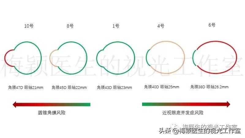 孩子眼轴比同龄人短却近视了,儿童眼轴未超过24mm怎么也近视了