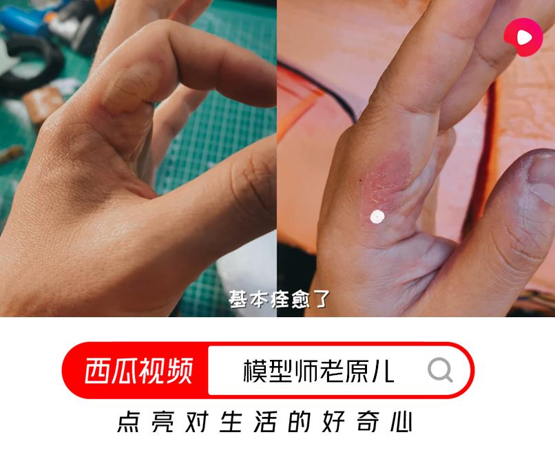 烫伤不小心把水泡戳破了怎么办,皮肤被烫伤起的水泡可以戳破吗