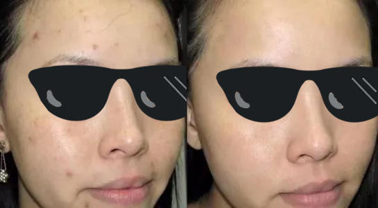 教你4个淡化黑色痘印的有效方法,改善痘印用什么酸效果最好