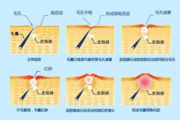嘴巴下巴红肿痛长痘痘用什么药,下巴长痘痘又痒又痛怎么回事