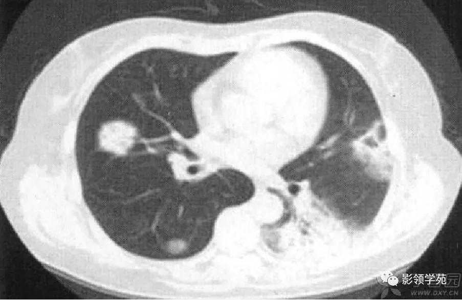 肺肉芽肿影像学表现ppt,肺韦格纳肉芽肿影像学表现