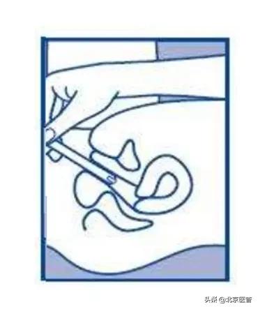 霉菌性阴道炎反反复复？药师教您正确用药，摆脱难言之隐